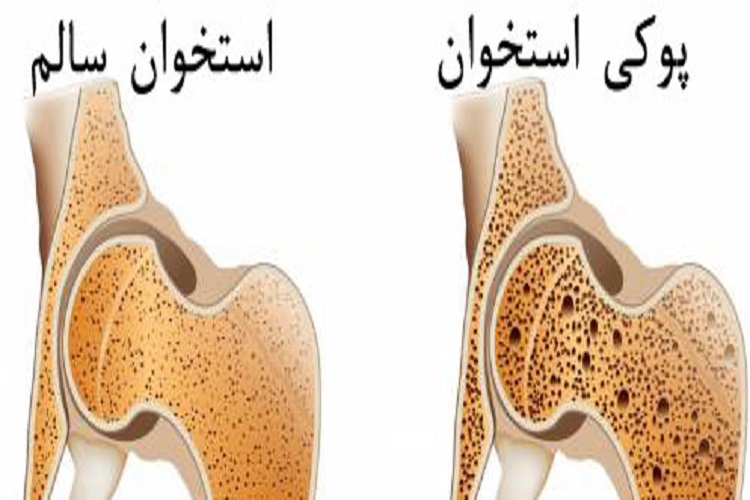پوکی استخوان (Osteoporosis)